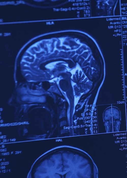 Neurocirurgia - Cirurgia cerebral e neurológica